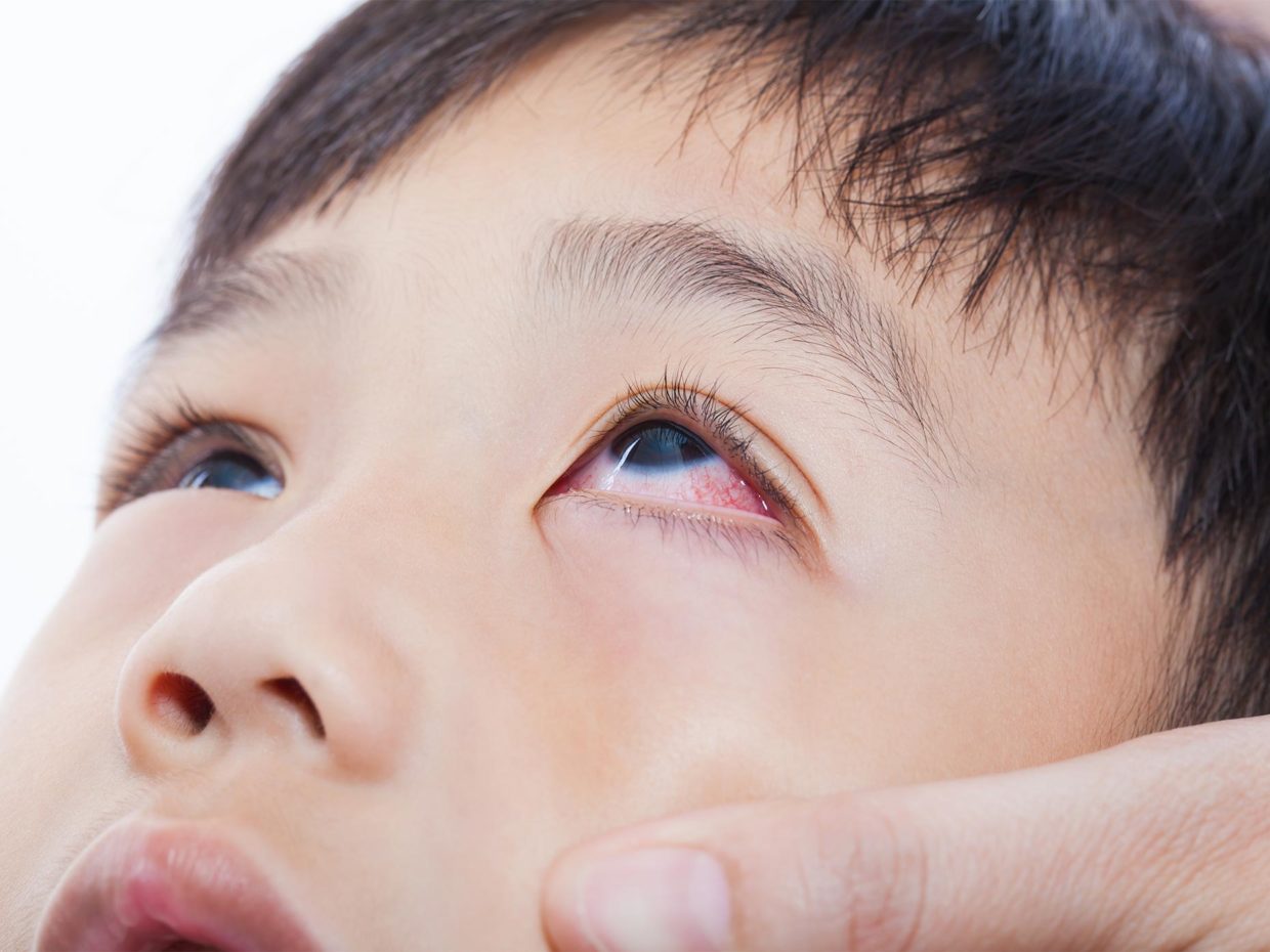 occhi di un bambino asiatico con congiuntivite allergica