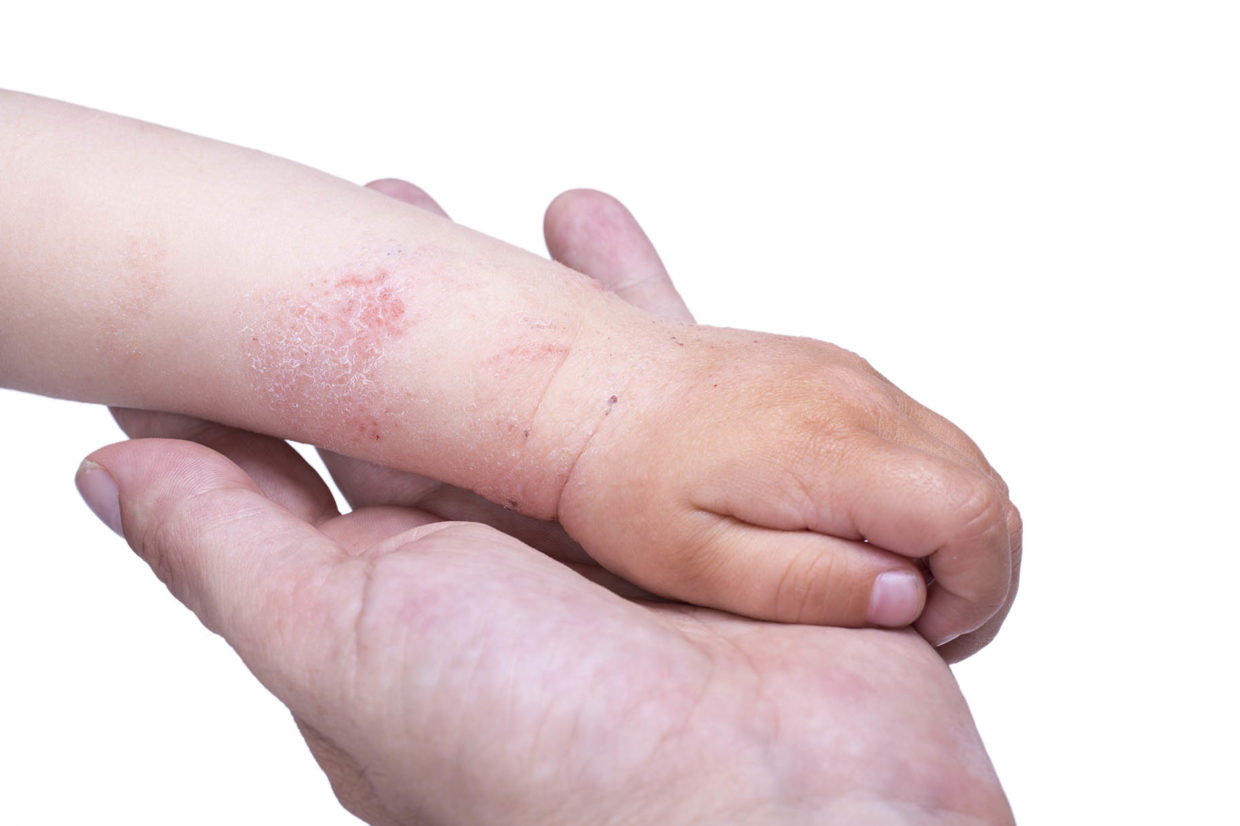 dermatite sul braccio e sulla mano di un neonato