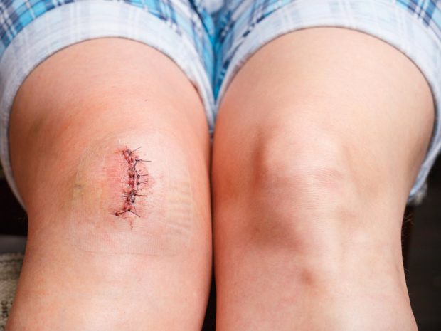 ginocchio bambino con punti di sutura