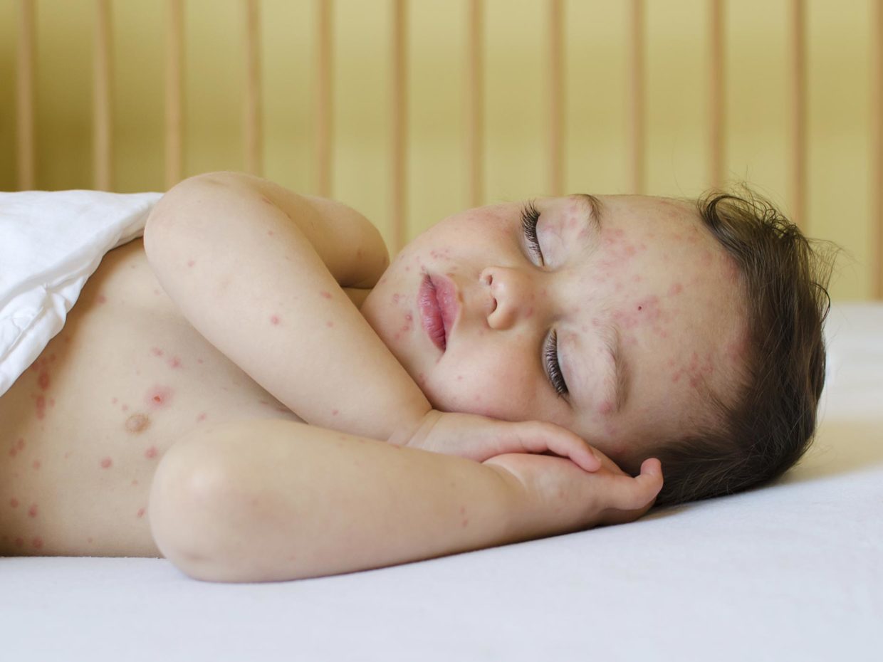 bambino con la varicella dorme tranquillo con la testa appoggiata alle braccia