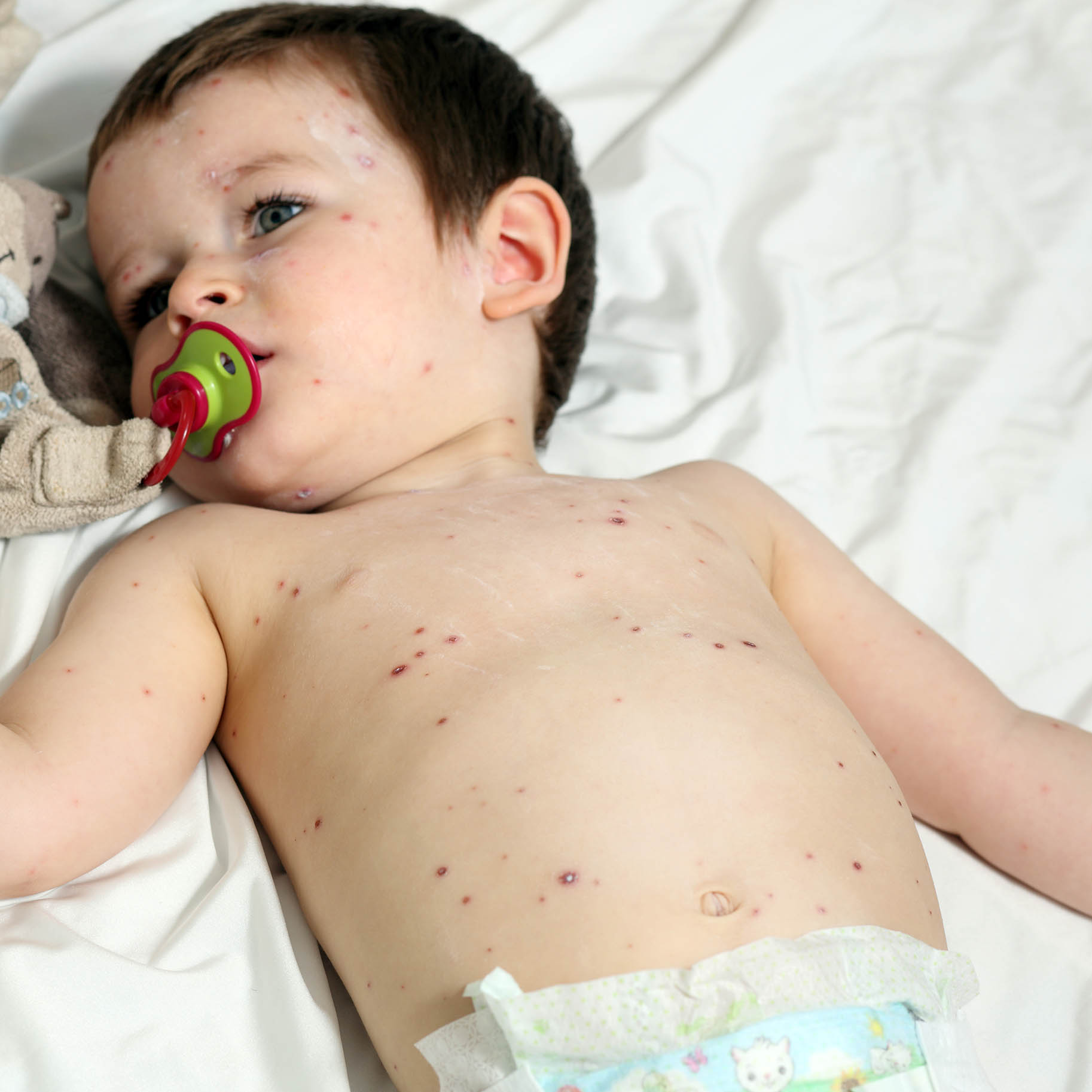 bambino disteso nel letto ricoperto da ponfi dovuti alla varicella
