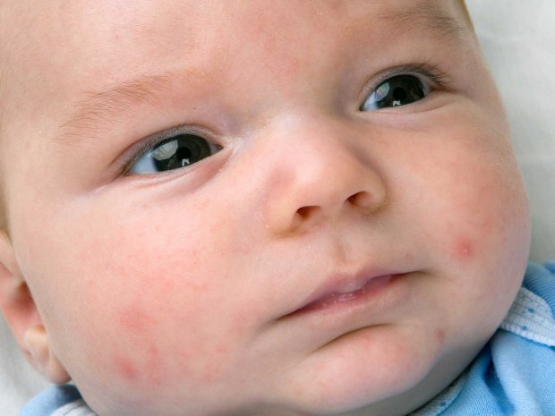 primo piano del viso di un bambino affetto da acne neonatale
