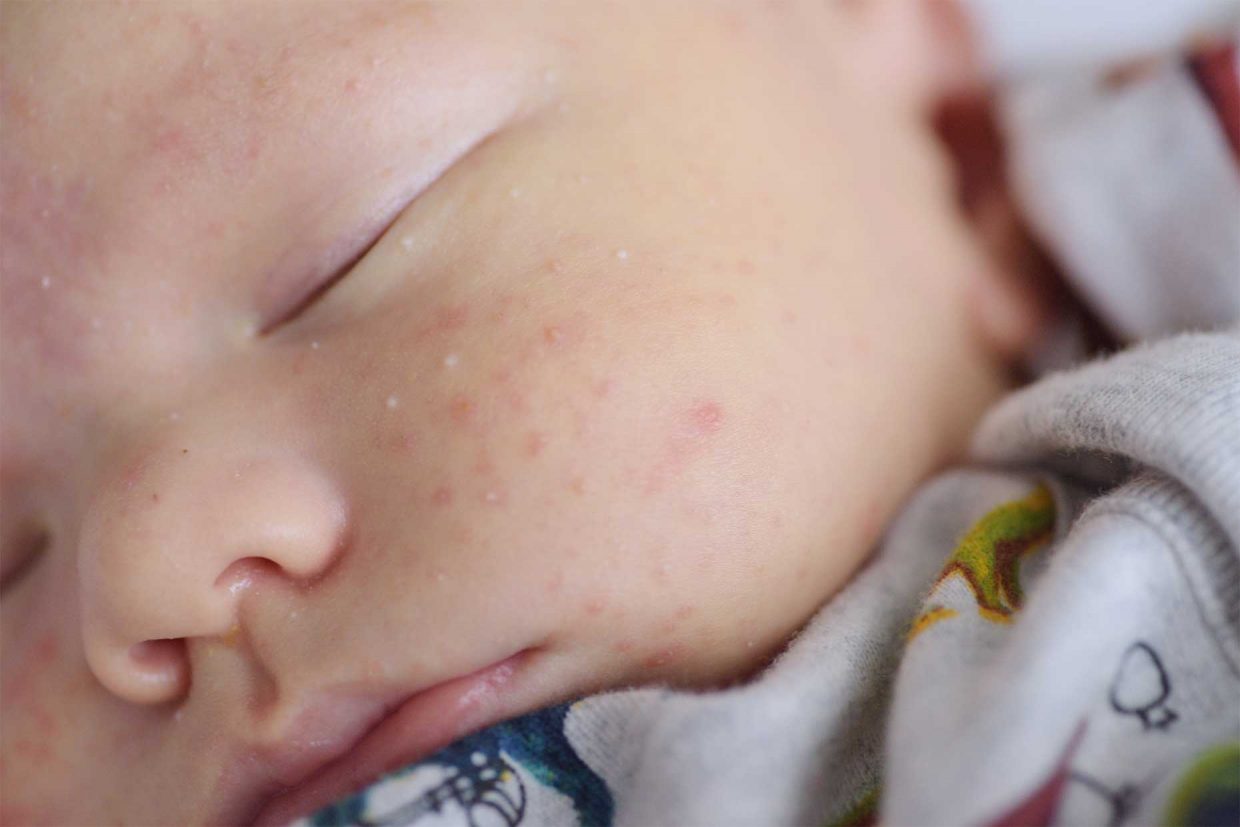 primo piano del viso di un neonato che dorme affetto da acne neonatale